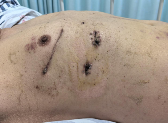 全胸腔镜手术切口(单侧)蒲强教授接受记者采访相较于横断胸骨,切开长